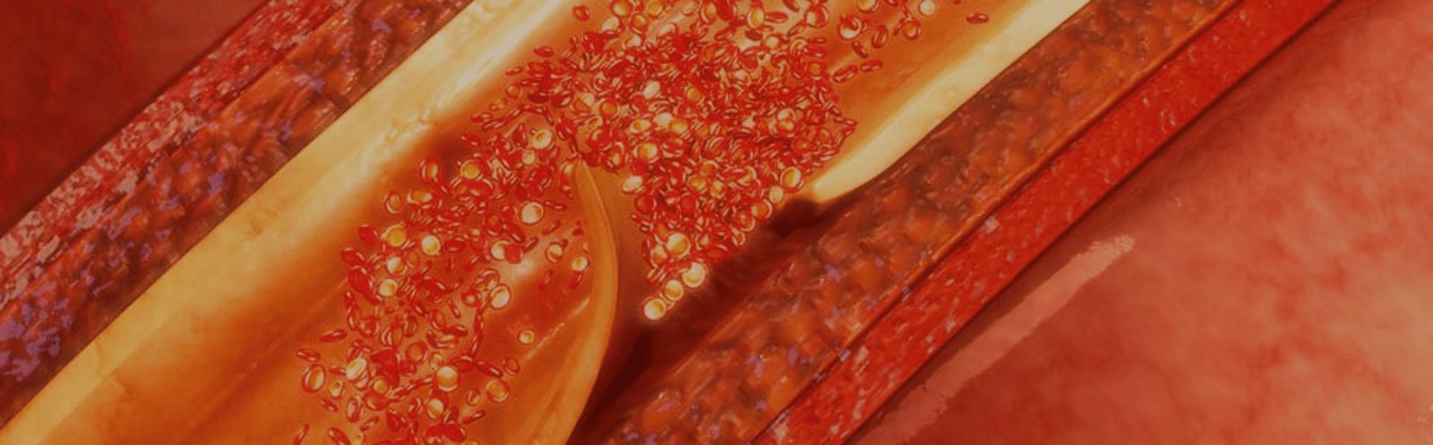 Implantes de Marcapasso